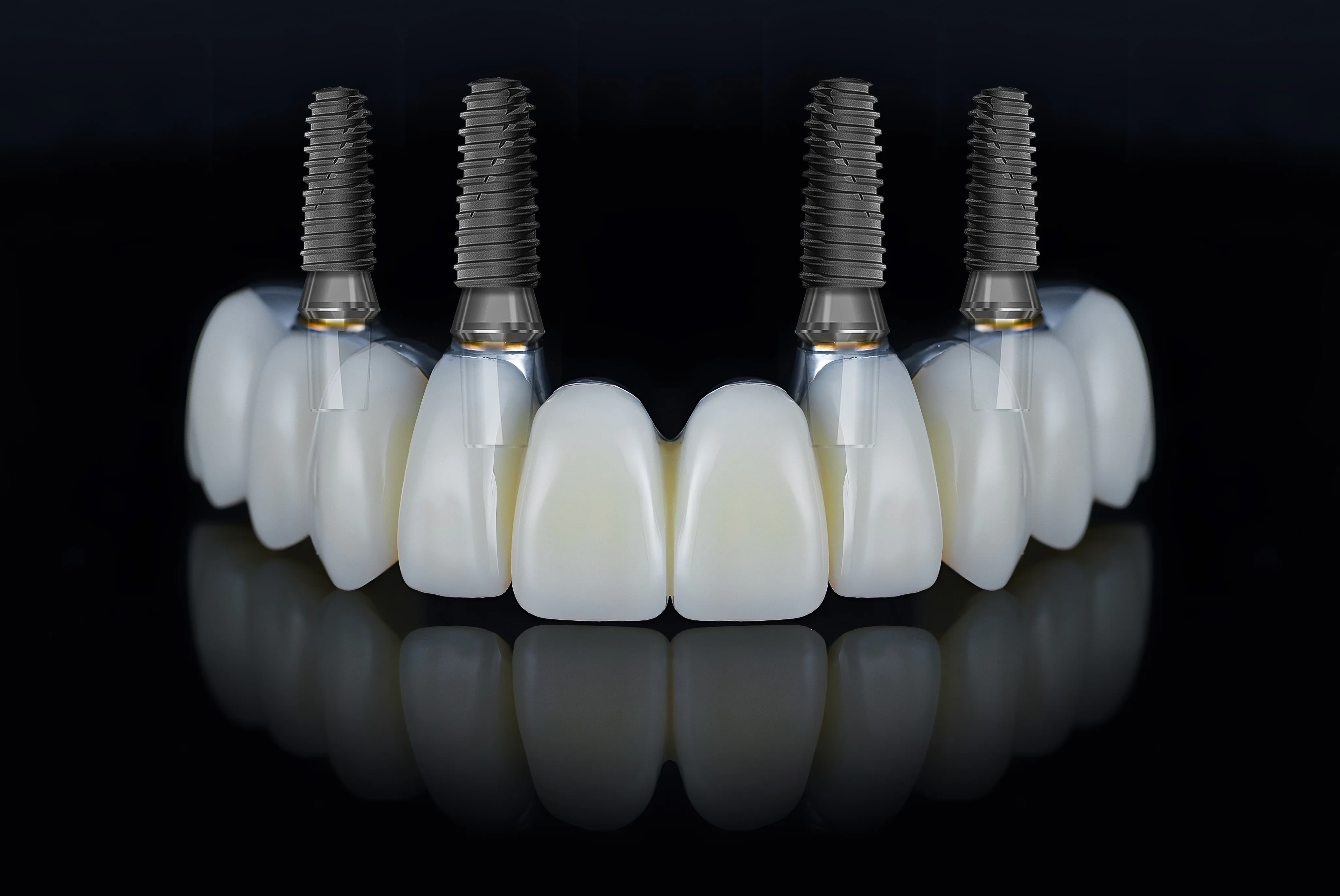 Dental Implant
Crowns at Sunshine Dentistry in San Diego