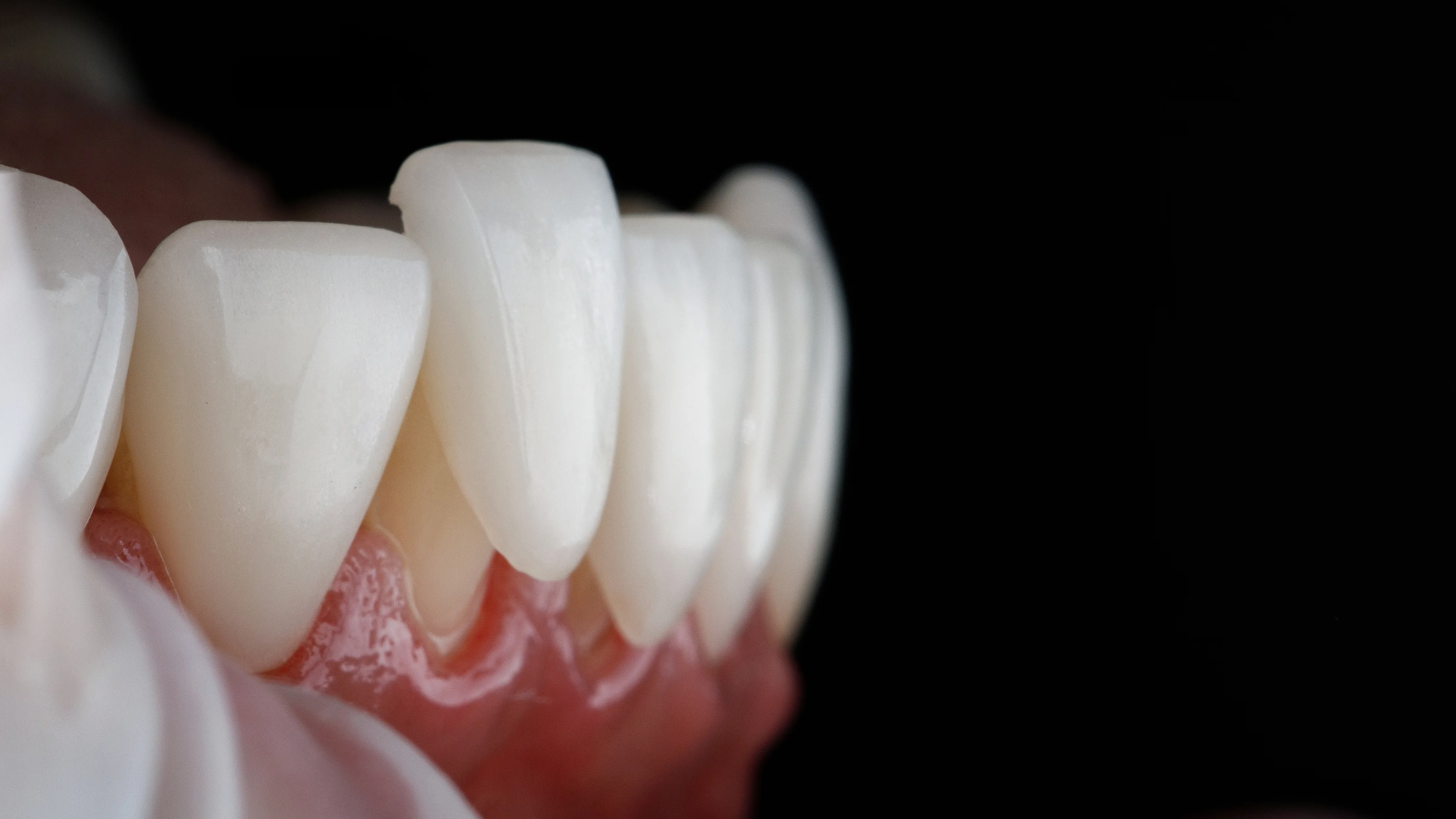 Dental
Veneers at Sunshine Dentistry in San Diego