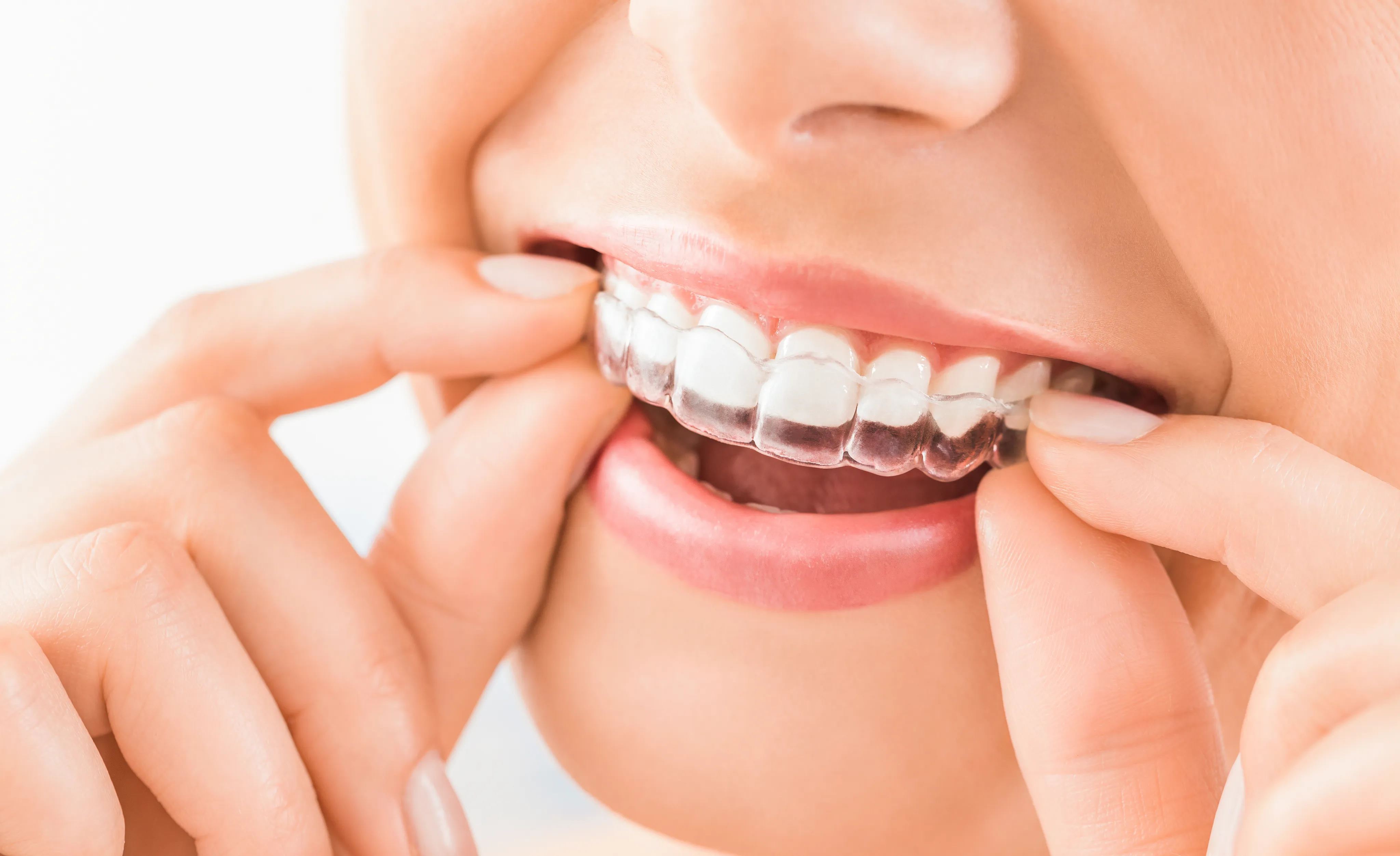 Patient inserting ClearCorrect clear aligner