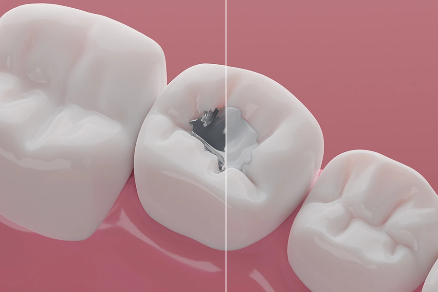 Dentist shade-matching tooth-colored filling material with patient
