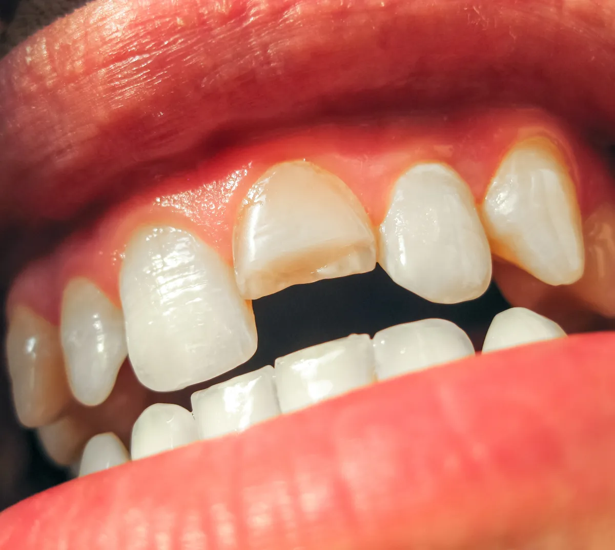 Dental Implant Crowns