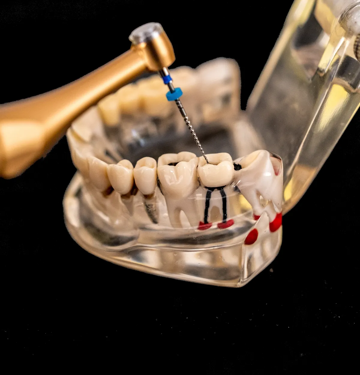 Restorative dental procedure in progress