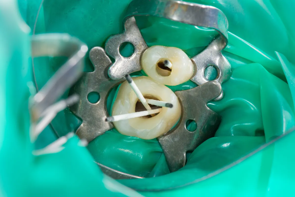 Dental restoration treatment
