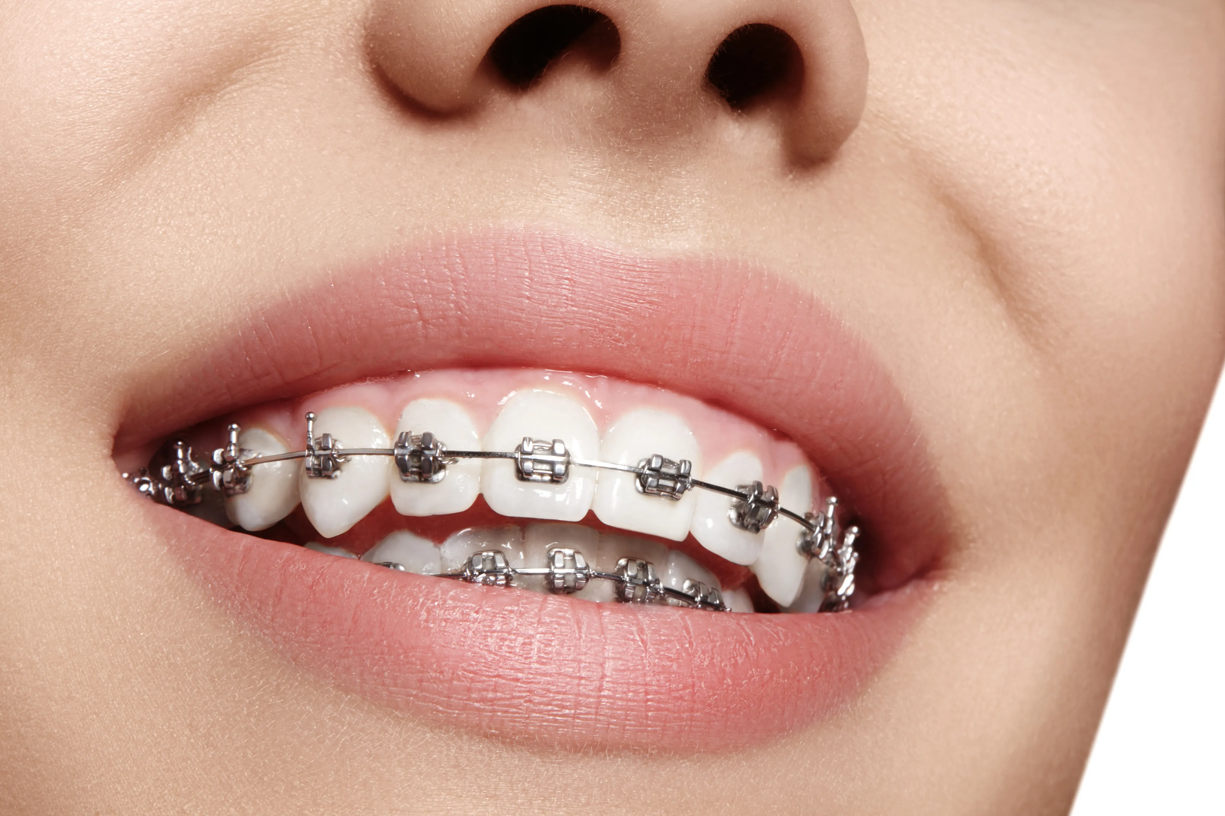 Orthodontics at Sunshine Dentistry in San Diego
