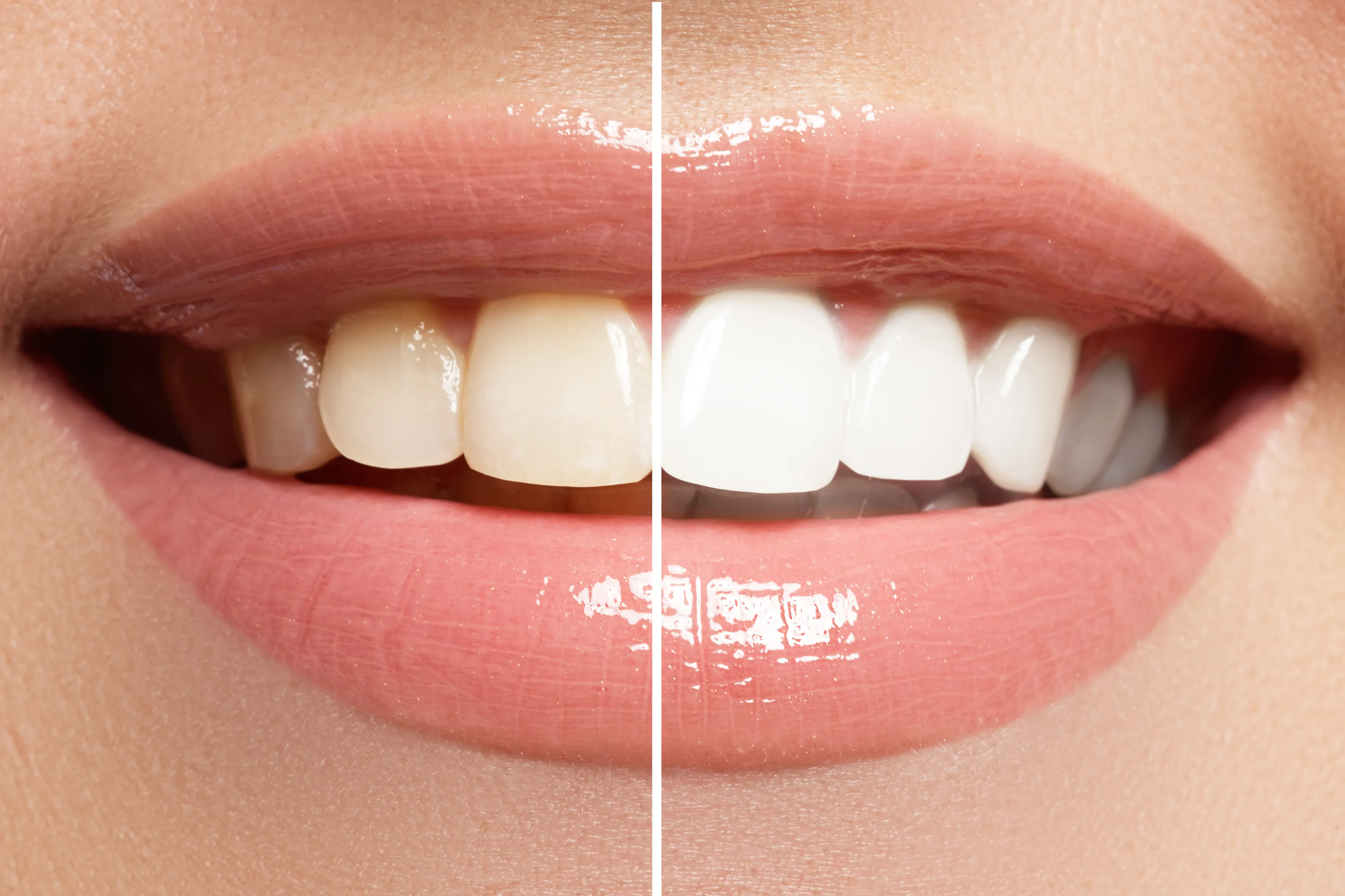 Before and after teeth whitening comparison